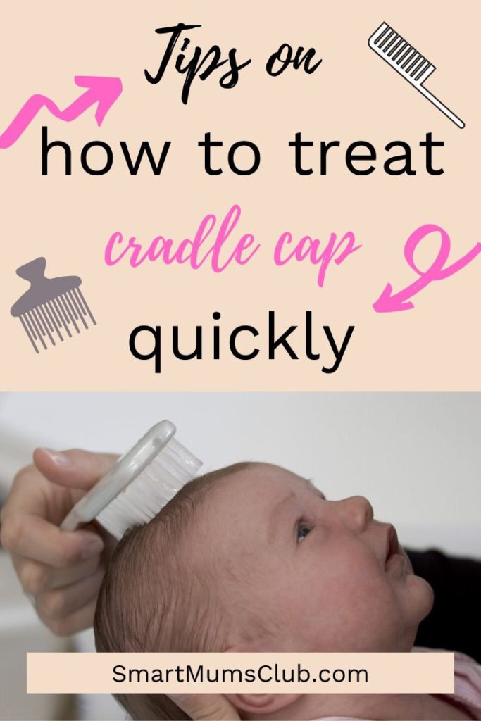 how to treat cradle cap