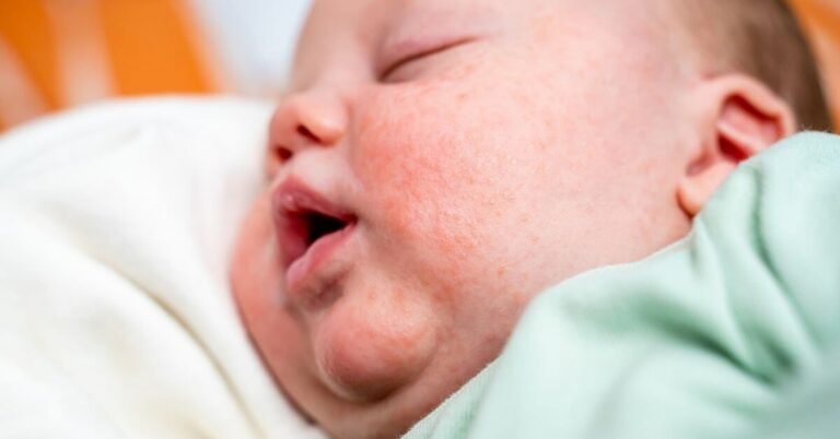 What causes baby acne and how to get rid of it?